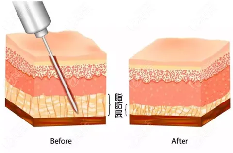 抽脂手術(shù)對(duì)身體有什么傷害？該不該禁止抽脂手術(shù)？